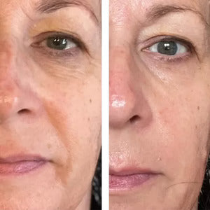 Haloral LED Light Therapy Face Mask