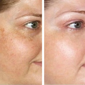 Haloral LED Light Therapy Face Mask