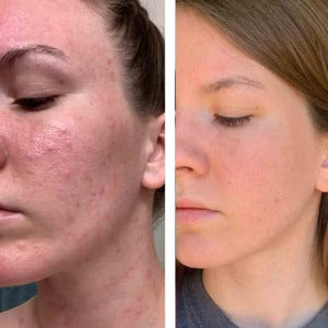 Haloral LED Light Therapy Face Mask