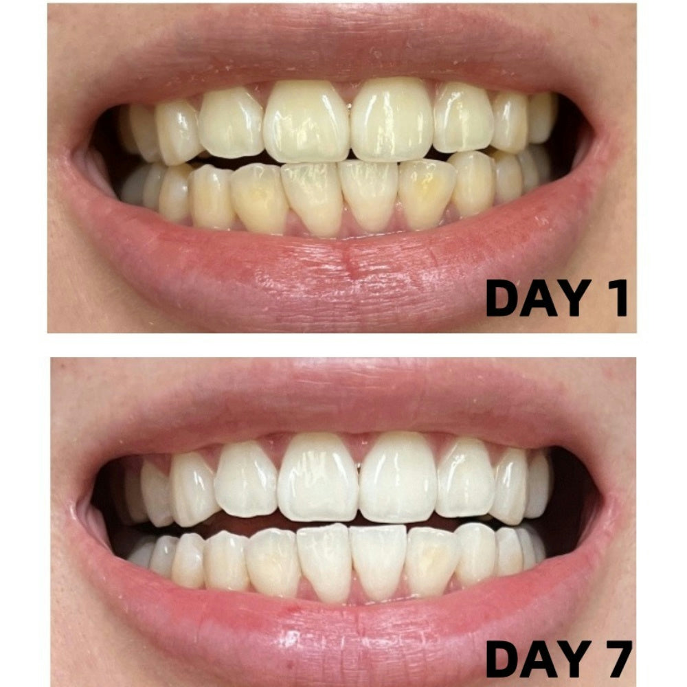 Haloral Halo Pro LED Wireless Teeth Whitening Kit