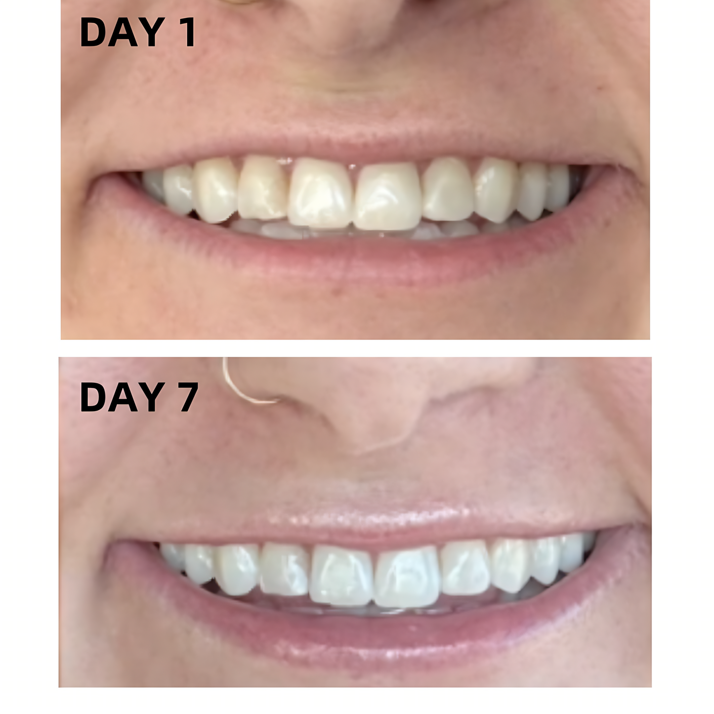 Haloral Halo Lite LED Wireless Teeth Polishing Kit