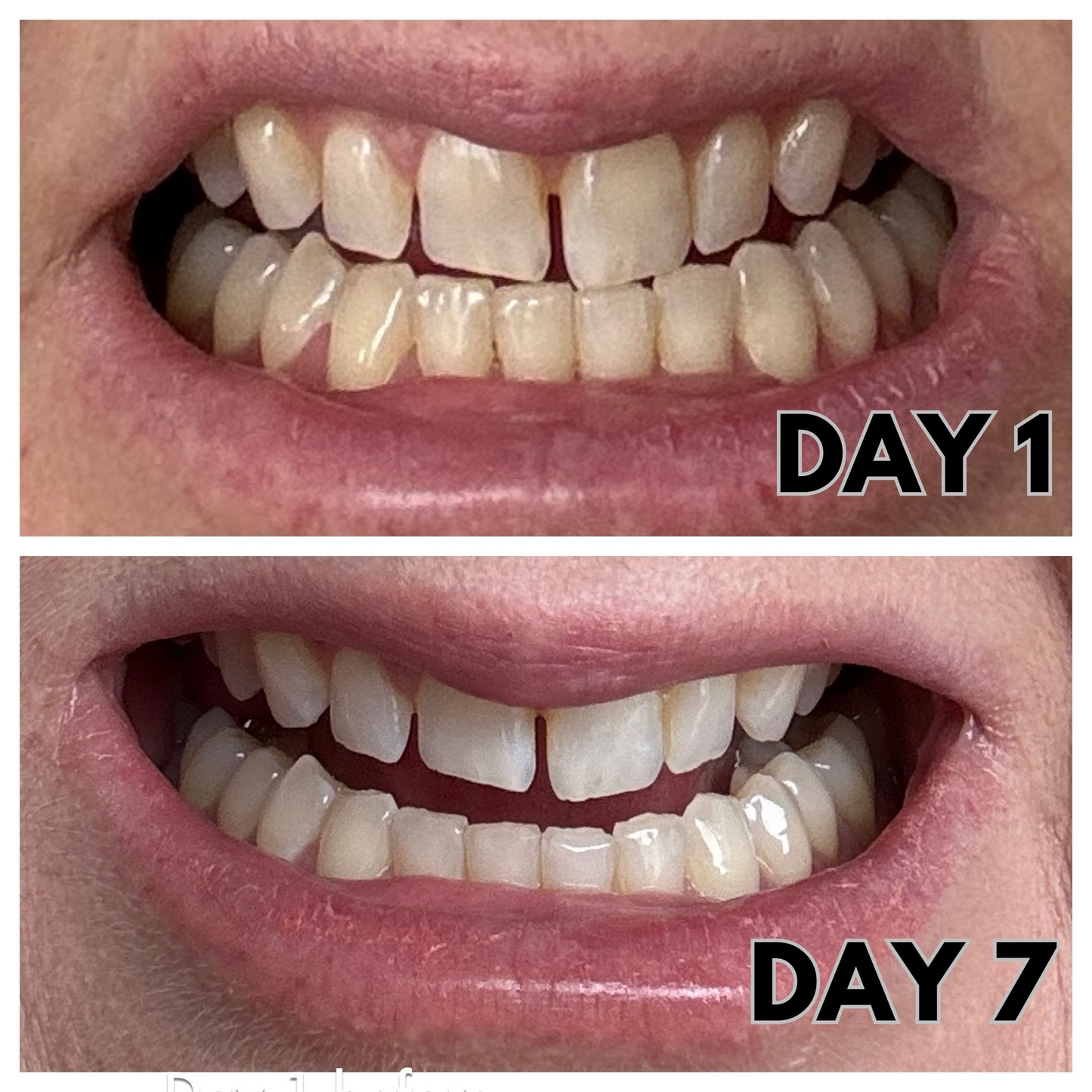 Haloral Halo Pro LED Wireless Teeth Whitening Kit