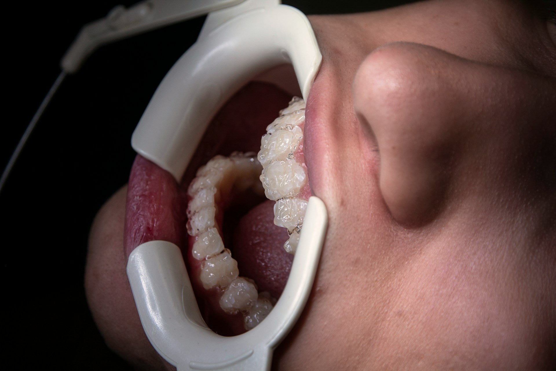 Close-up of a person undergoing a professional dental whitening treatment, representing sensitivity solutions.
