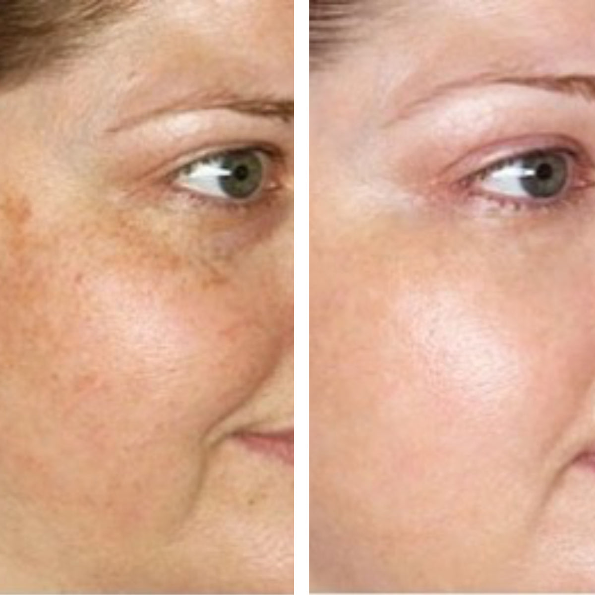 Haloral LED Light Therapy Face Mask