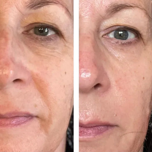 Haloral LED Light Therapy Face Mask